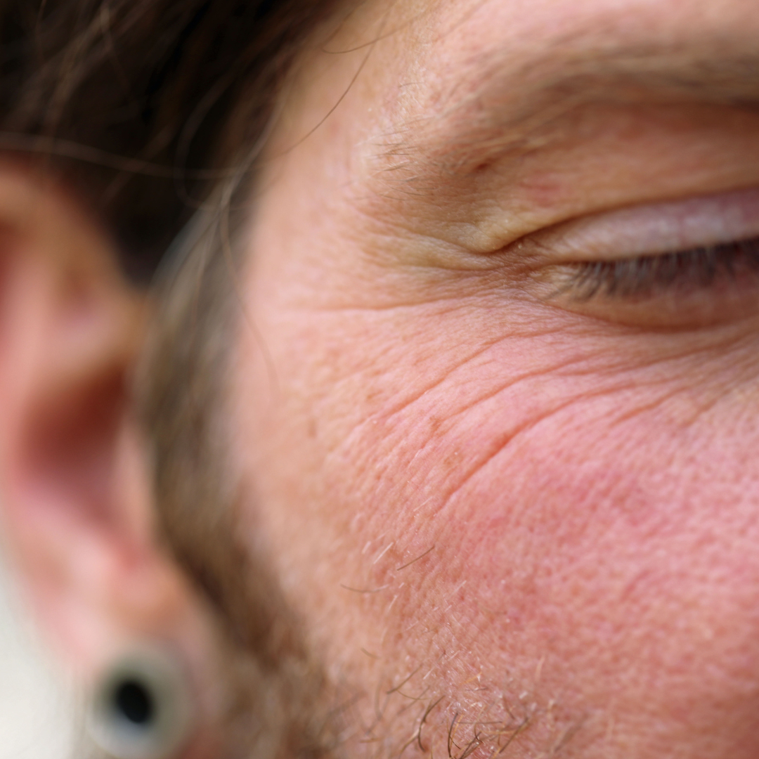 Skin Condition Dynamic Wrinkles & Poor Texture