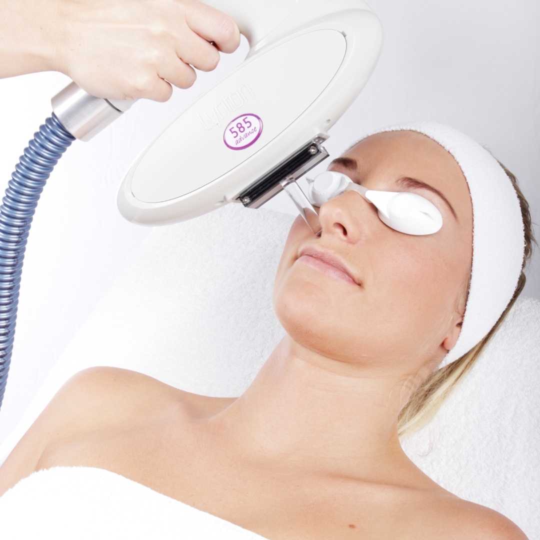 Lady having Lynton IPL treatment on her face