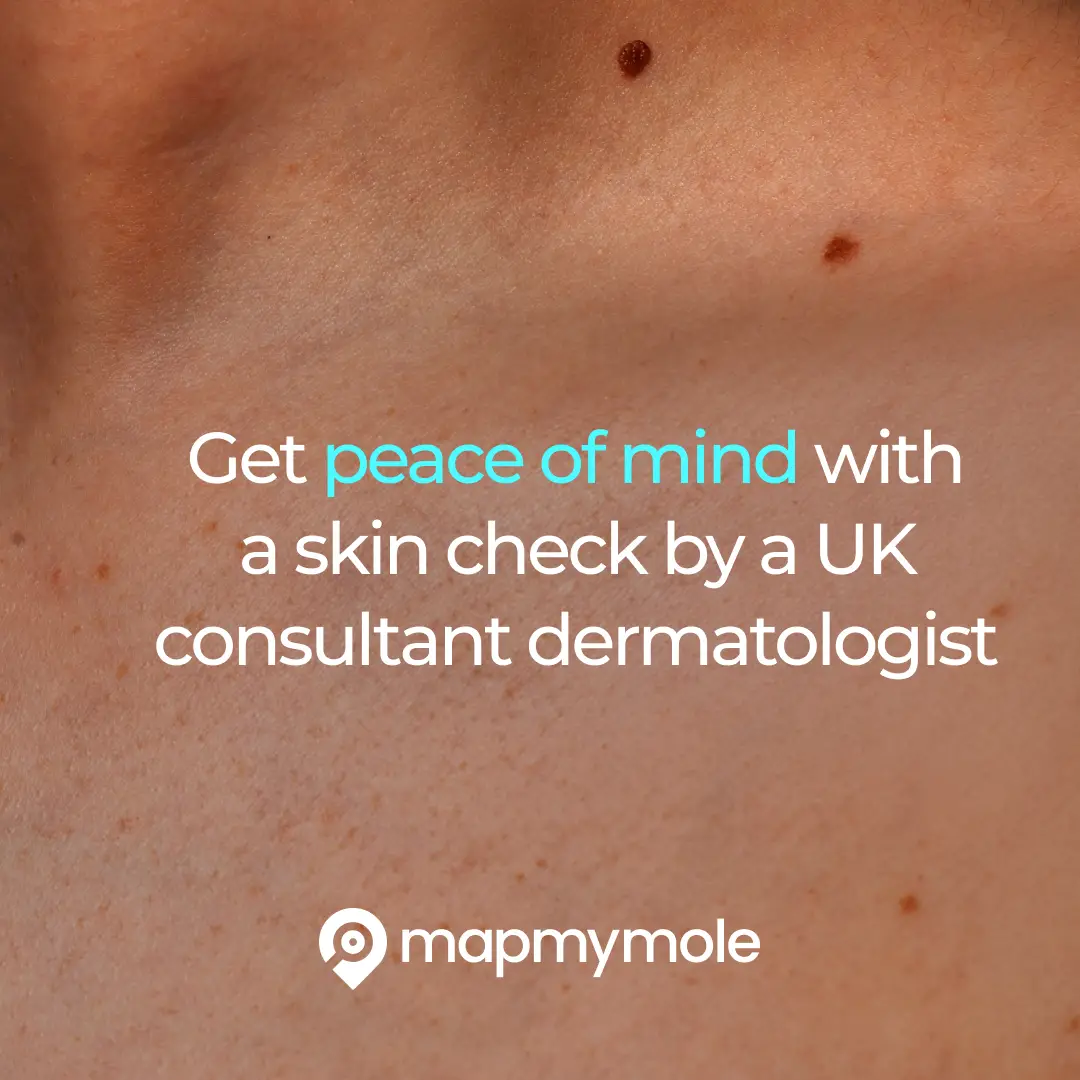 Clinician capturing dermoscopic image of a mole during mole mapping consultation at Hannah Tress Advanced Skincare in Hampshire.